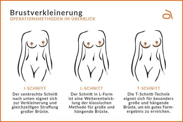 Brustverkleinerung Köln